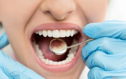 Diş Çürümesinin Nedenleri