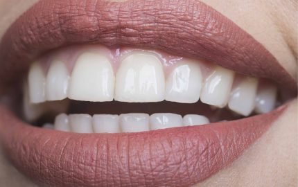 Zirkonyum diş kaplama hakkında bilmeniz gerekenler